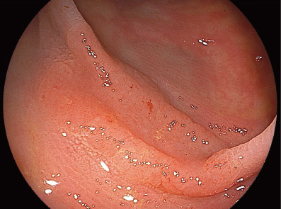 写真:figure1:早期の大腸がん(真ん中の陥凹した部分)