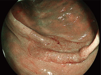写真:figure1:早期の大腸がん(真ん中の陥凹した部分)