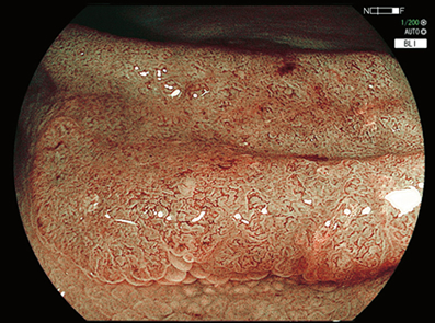 写真:figure1：早期の大腸がん(真ん中の陥凹した部分)
